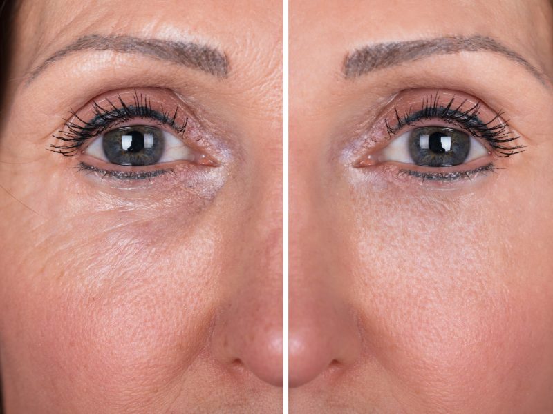 Photo Of Anti-aging Procedures On Caucasian Woman Face